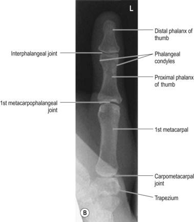 <p>First metacarpophalangeal joint</p>