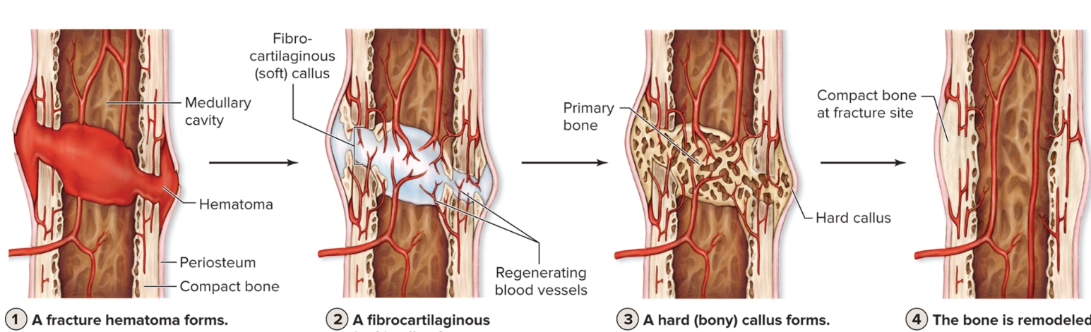 <p>What are the four steps of fracture repair?</p>