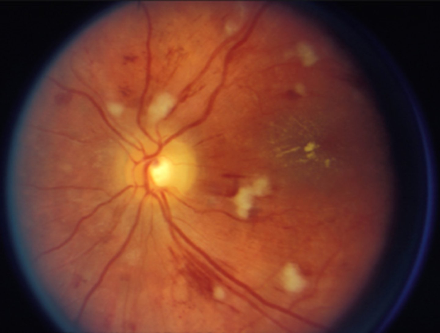 <p>grade 4 HTN retinopathy causing disc edema</p>
