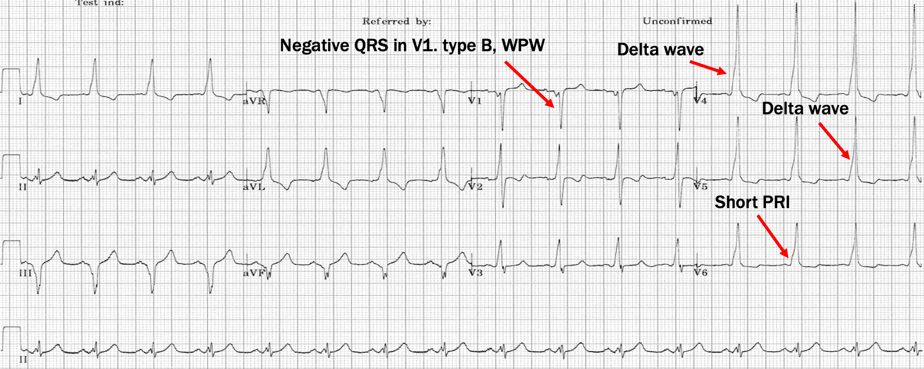 <p>Right sided Kent bundle produces QRS complex that is mostly neg in V1</p>