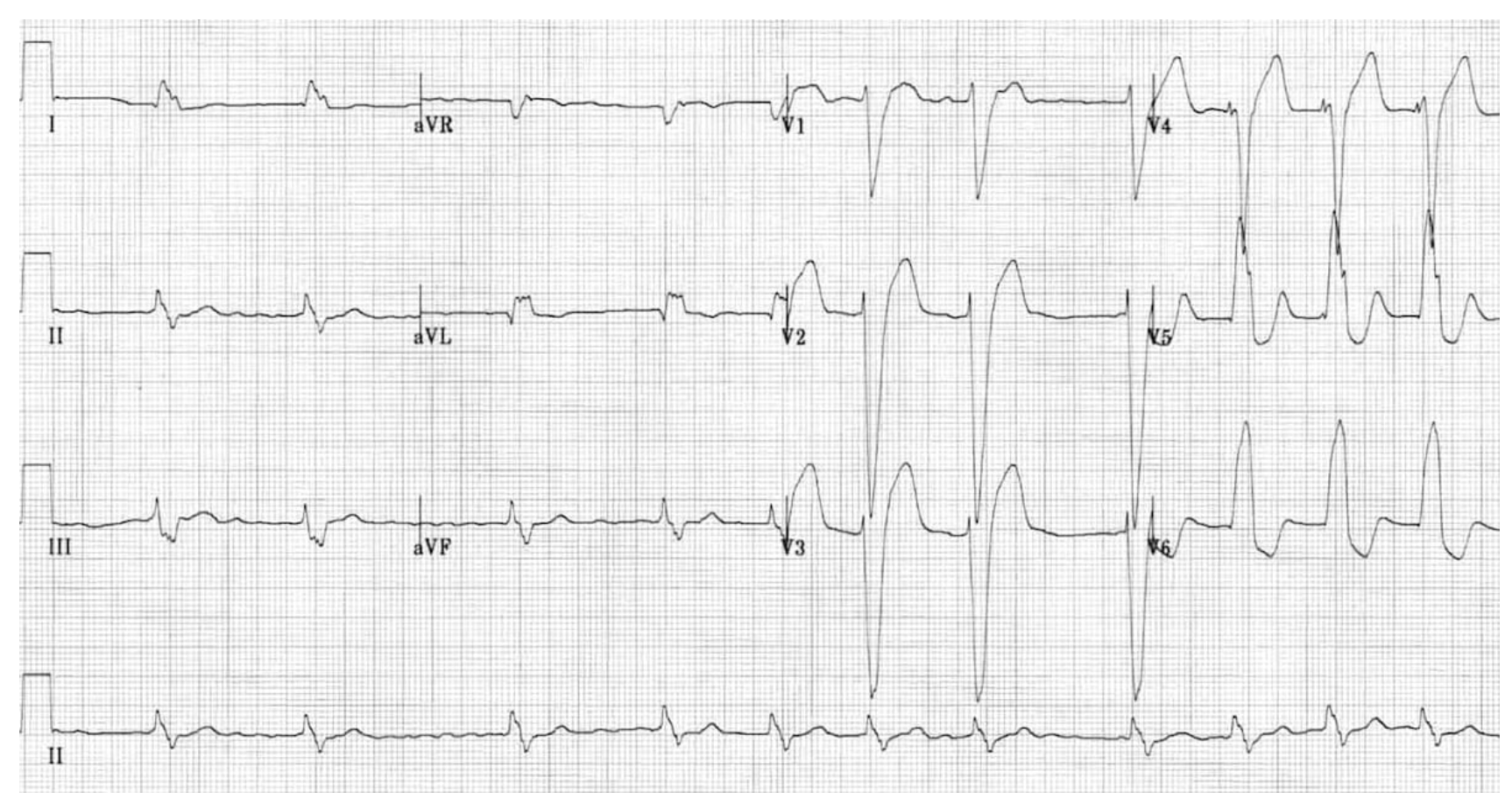 <p>What is recommended for patients with a BBB, depressed systolic function, heart failure, and a QRS greater than 3 small blocks</p>