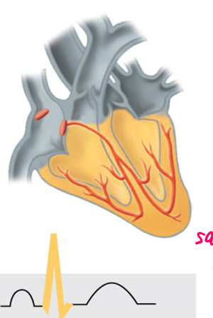 <p>What happens at the sharp point of the ECG</p>