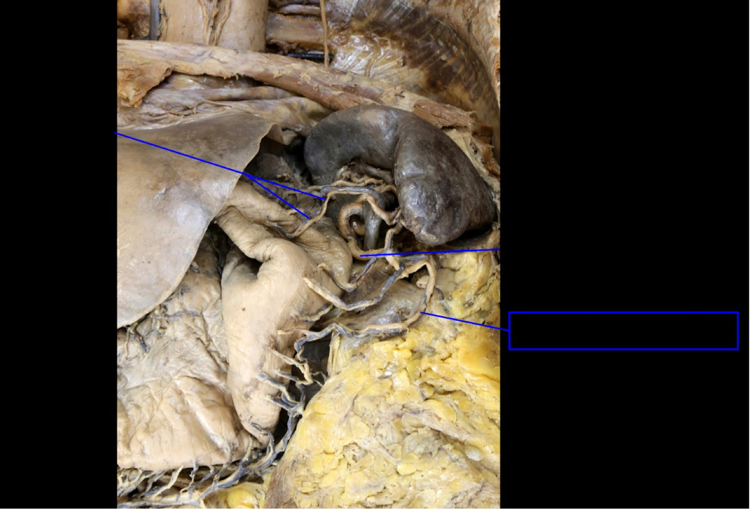 <p>A). Identify this structure<br>B). What other structure does this anastomose with?</p>
