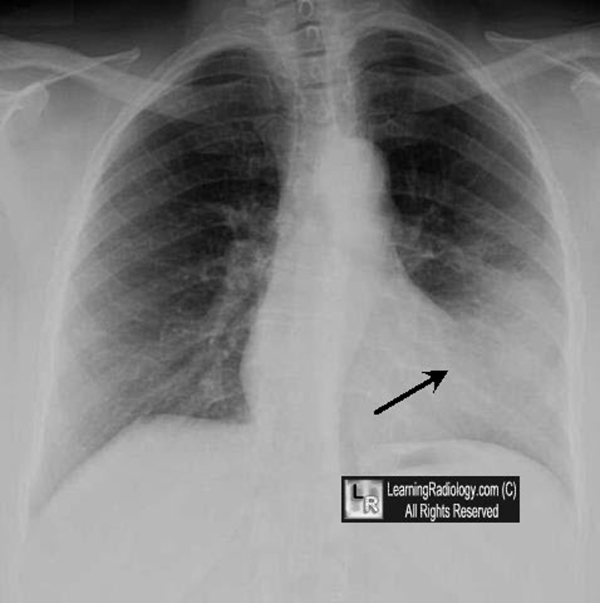 <p>almost vertical, formed mainly by the left ventricle (on x-ray)</p>