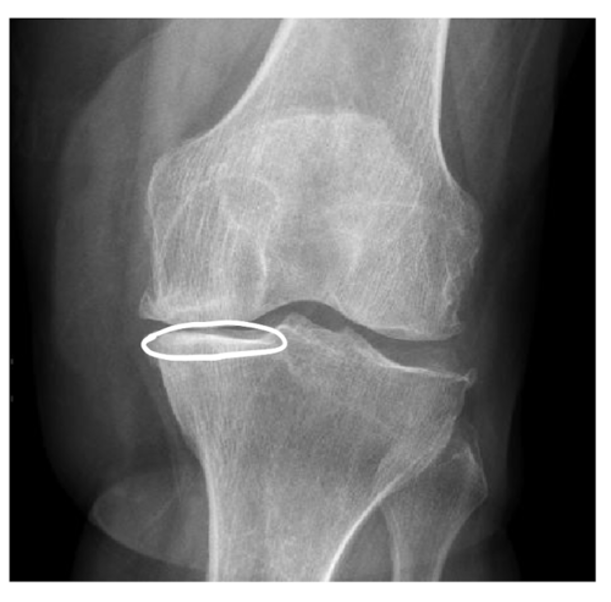 <p>Hardening of the bone tissue at the joint line (often a primary indicator of OA)</p>