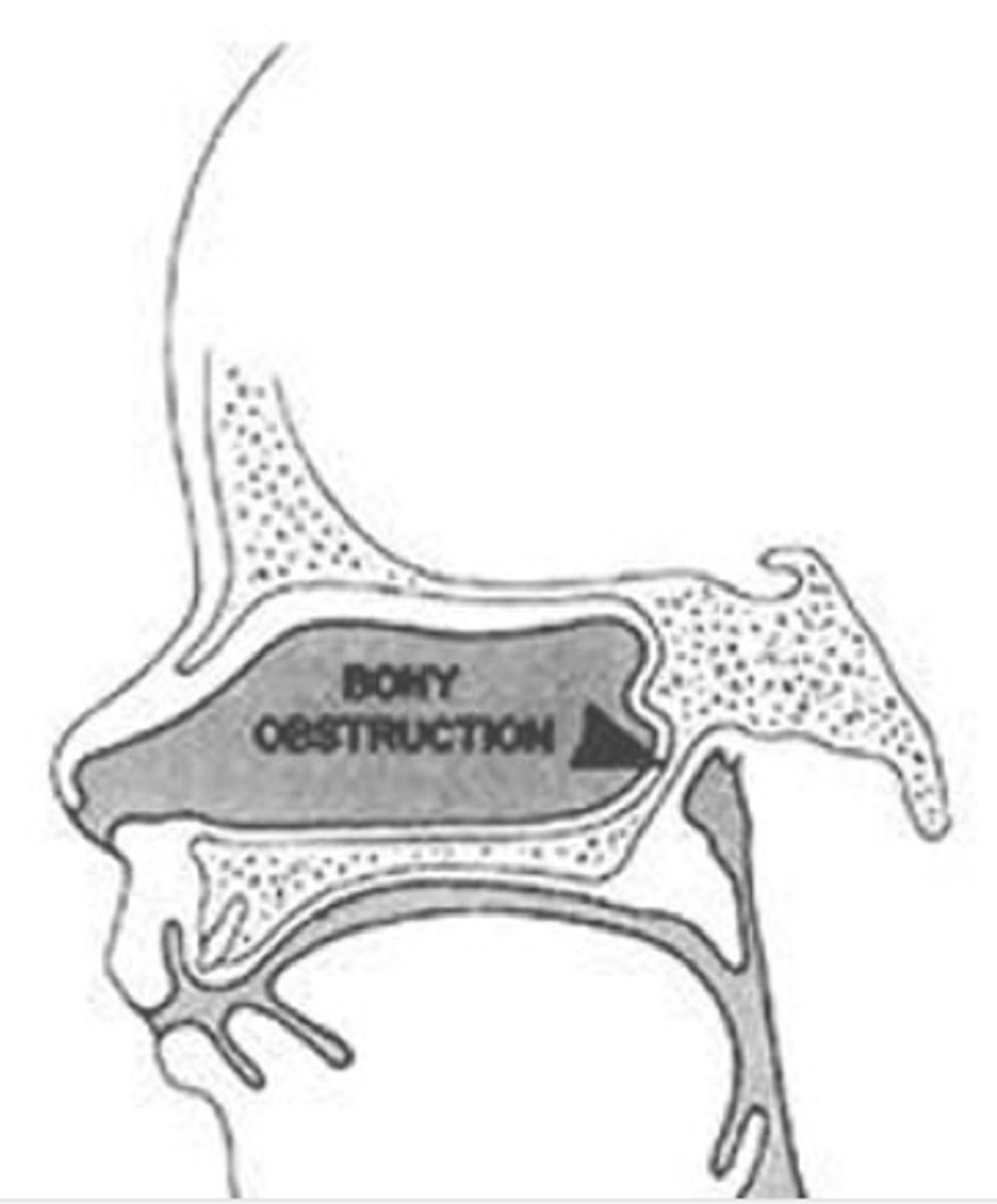 <p>blockage of nasal opening</p>