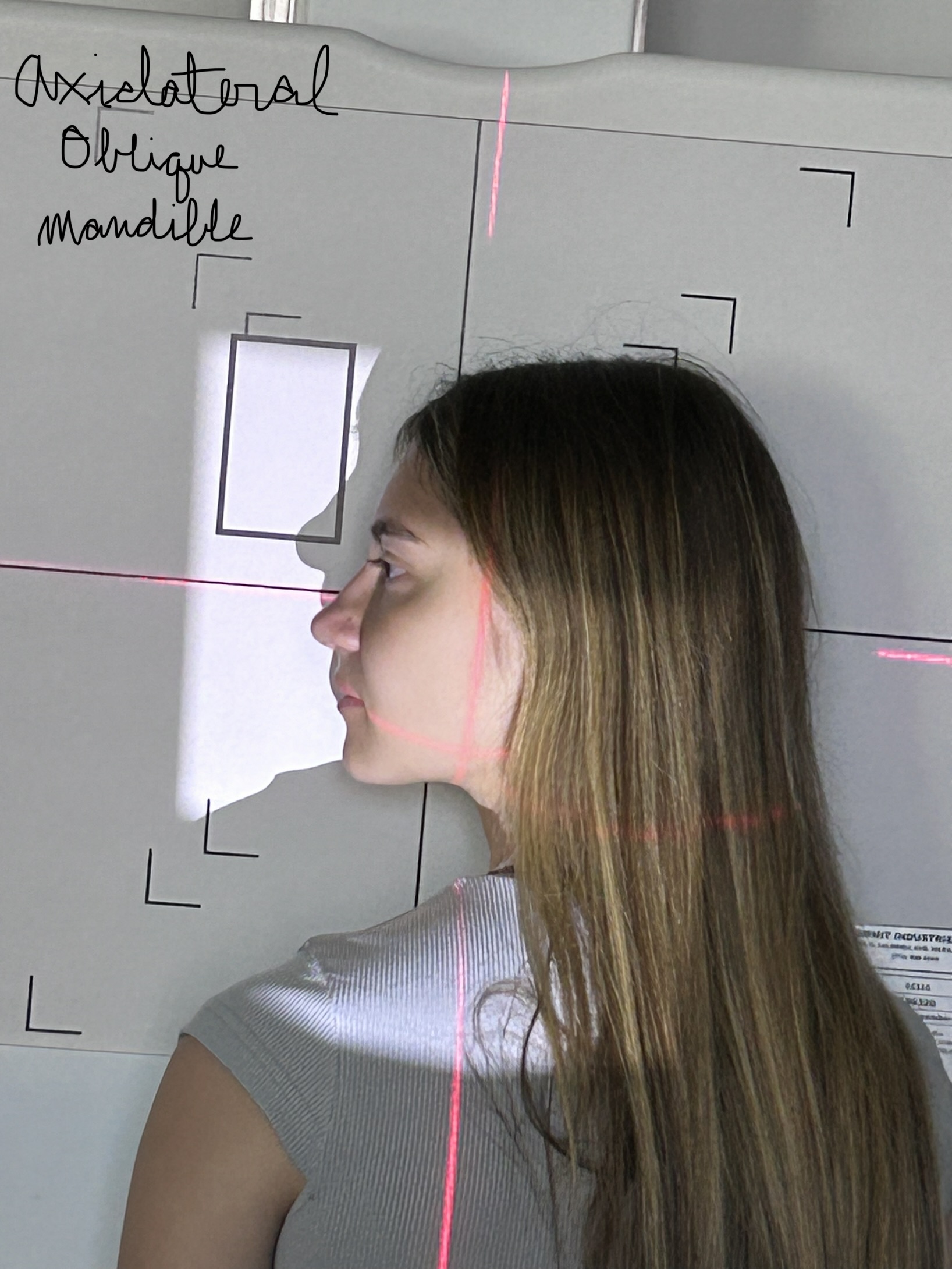 Axiolateral Oblique Mandible (Ramus)