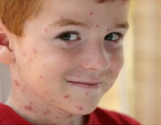 <p><span style="color: red">Varicella (Chickenpox) —S/S </span></p>