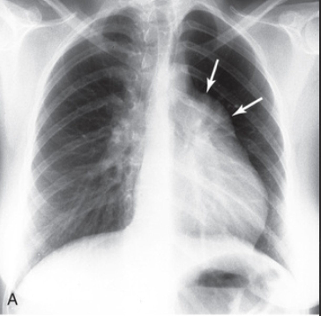<p>- Enlargement of pulmonary artery</p><p>- increase in the size of the right atrium and right ventricle</p>