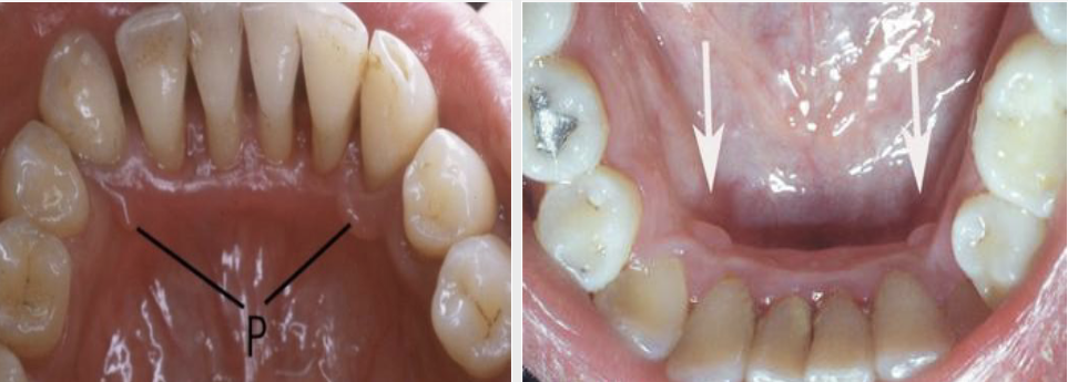 <p>A sessile nodule on the gingival margin of the lingual aspect of the mandibular cuspids</p>