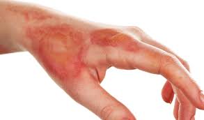 <p>Entire epidermis and maybe some of dermis damaged. \n Blistering, pain, and swelling occur. \n Infection can develop from ruptured blisters.</p>