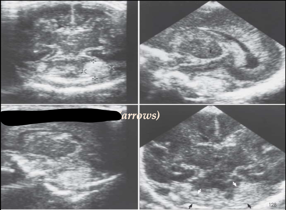 <p>What pathology is being shown?</p>