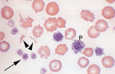 <ul><li><p>RBC fragment</p></li><li><p>shearing of RBC via IV trauma</p></li><li><p>disseminated introvascular coagulopathy - DIC</p><ul><li><p>RBC broken by fibrin strands &amp; iron deficiency </p></li></ul></li></ul><p></p>