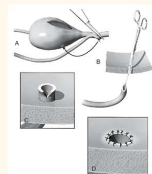 <ol><li><p>stay suture at diatl portion of ureter</p></li><li><p>suture up defect region in urethra</p></li><li><p>create a hole</p></li><li><p>pull ureter through into urinary bladder lumen</p></li></ol><ul><li><p>create spatulation to make surface area of hole larger</p></li></ul><ol><li><p>simple interupted suture—> urothelium to urothelium</p></li></ol><p>—> refer</p>