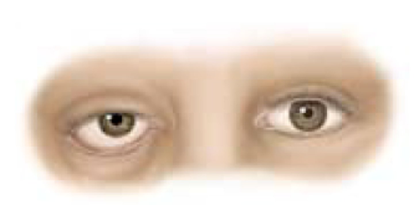 <p>Damage to a nerve in the autonomic nervous system. This nerve comes through the neck and base of the skull and controls eye functions.</p><p>Signs of nerve damage: 1) constricted pupil 2) upper eyelid droops 3) third eyelid protrudes 4) eye sunken in the socket</p>