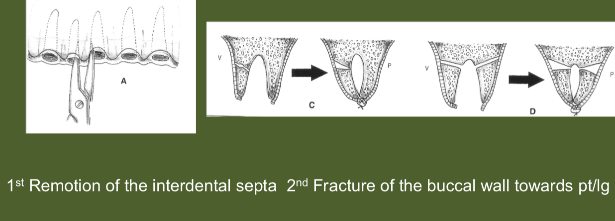 <p>Reduction of alveolar socket by compressing buccal cortical bone towards lingual wall after excision of interdental bone septa </p>