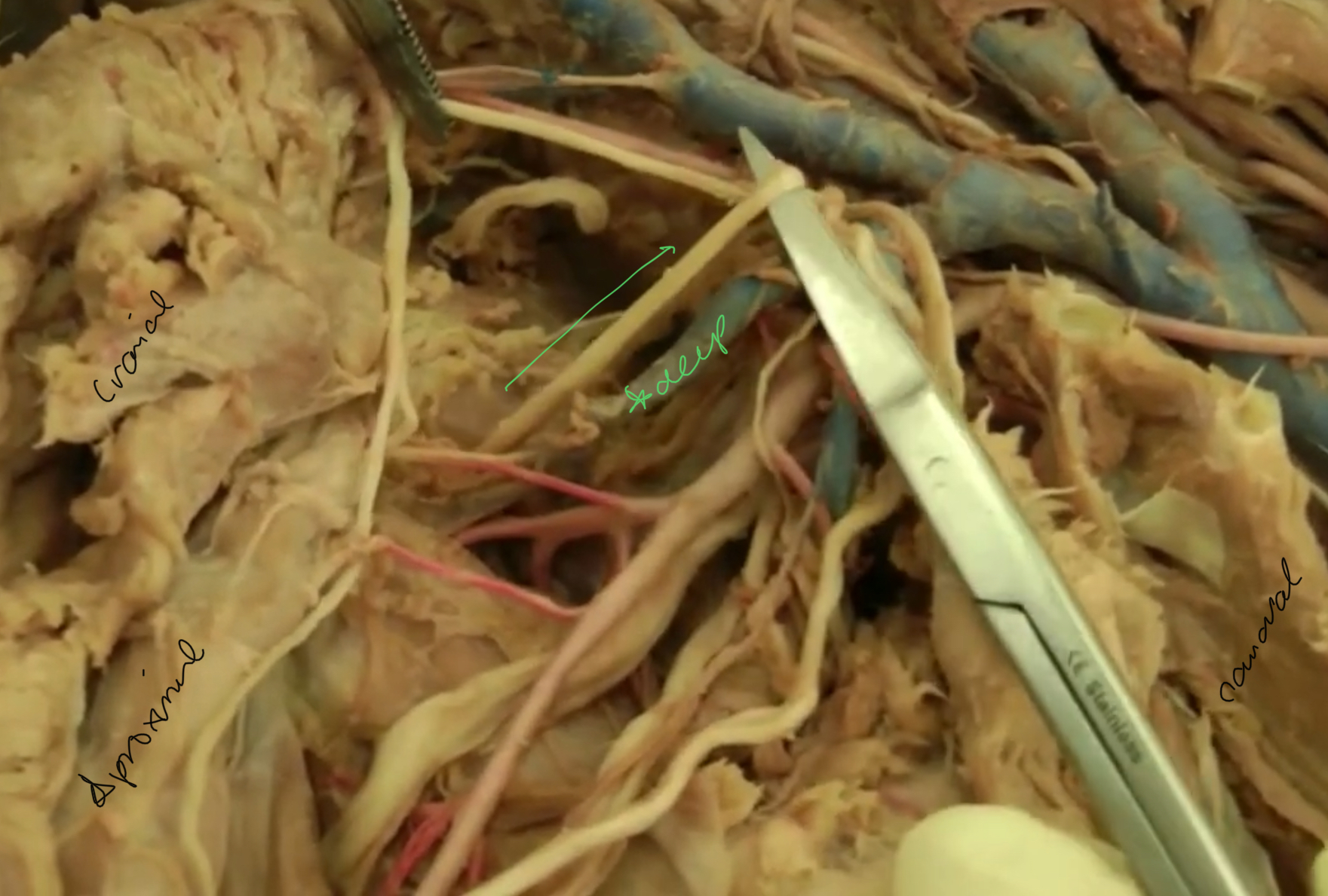 <p>what nerve is highlighted?</p>