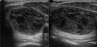 what thyroid pathology is shown here?