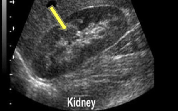 <p>a renal mass&nbsp;</p>