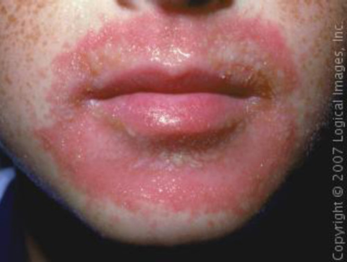 <p>localized inflammatory response to chemical or physical agents</p>