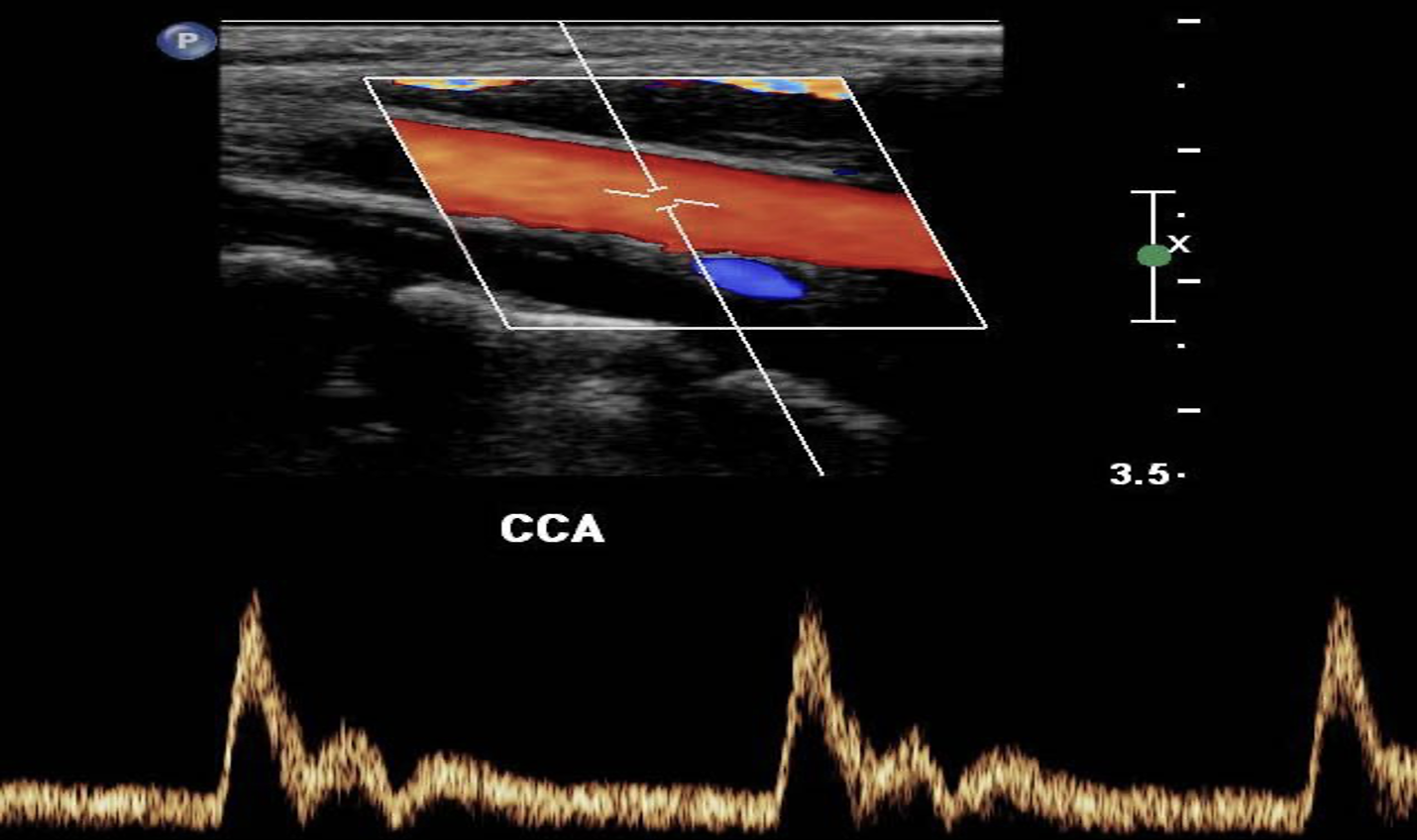 <ul><li><p>consists of a continuous pulsed-wave form. </p></li><li><p>Shows the velocities of moving RBCs</p></li><li><p>shown to you as a Spectral Waveform.</p></li></ul>