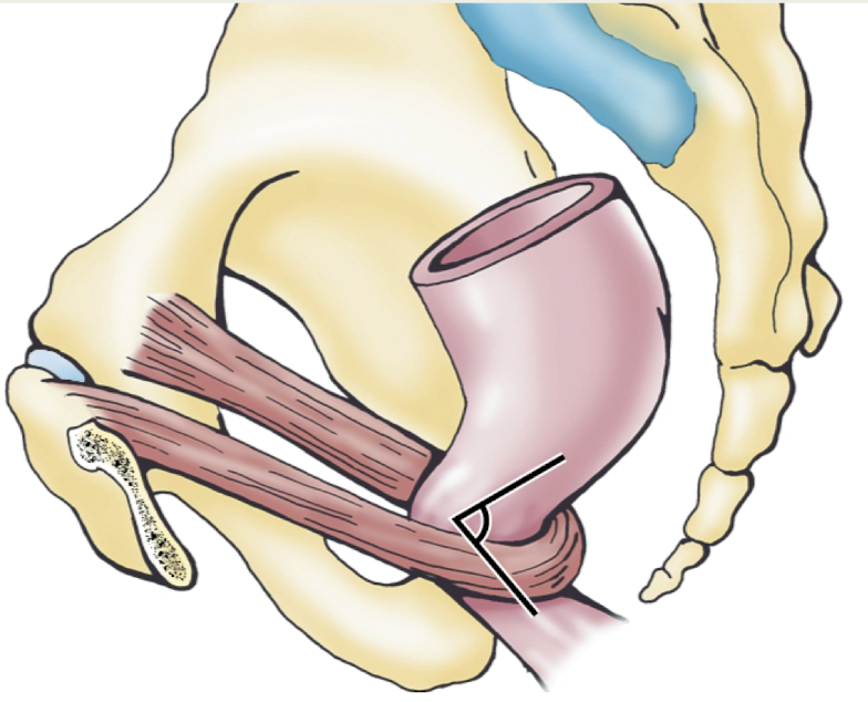 <p>levator ani m (<strong>S4 ventral rami innervation</strong>) of pelvic diaphragm (floor)</p><p>attached laterally to pubic bone, makes a u-shaped sling around the rectum; <strong>helps to maintain fecal continence</strong></p>