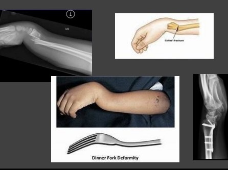 <p>what is this fracture? </p>