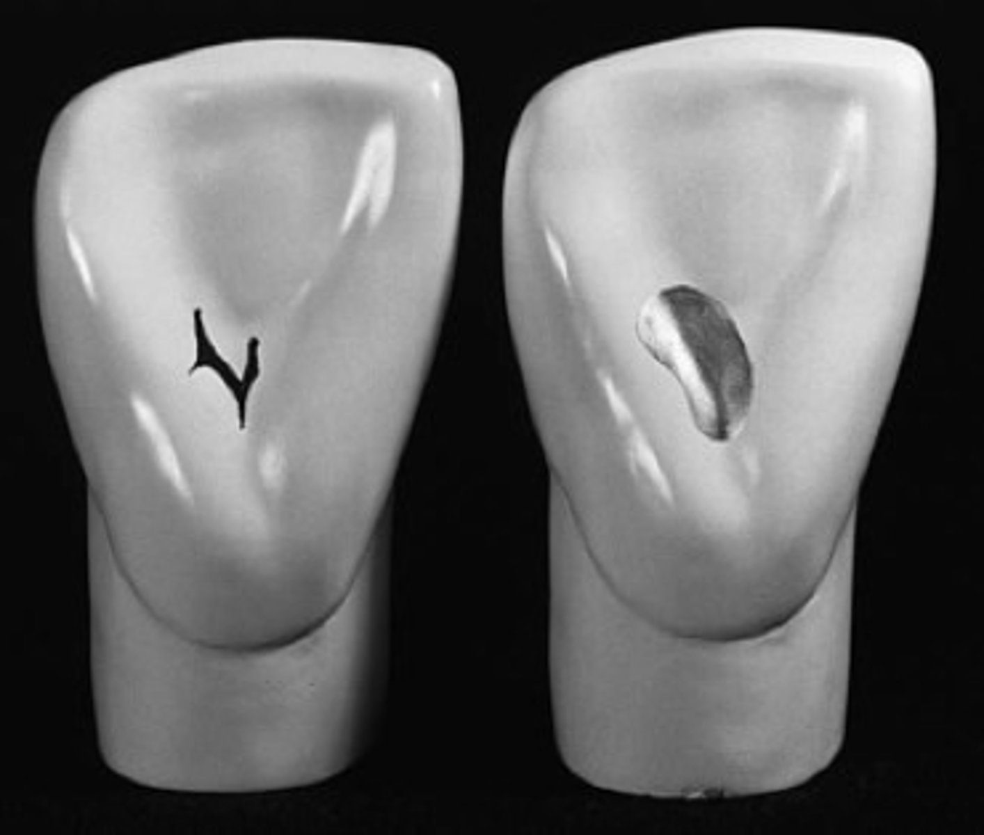 <p>lingual pit + defect (lots of variation in lateral incisors)</p>