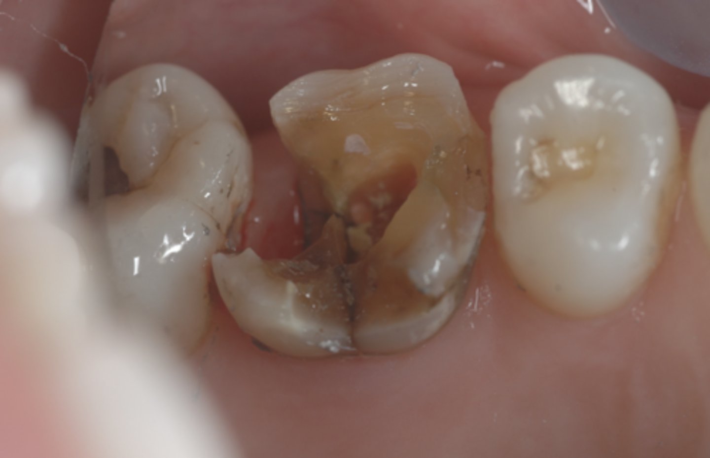 <p>Would you consider place a post on this tooth? If so, which type of post should you choose?</p><p>A) Yes, I would and will plan to choose a prefabricated post since there are some tooth structure left.</p><p>B) Yes, I would remove all of the undermined tooth structure and place a cast post/core.</p><p>C) No, I would not since there are substantial amount of tooth structure left more than 75%.</p>