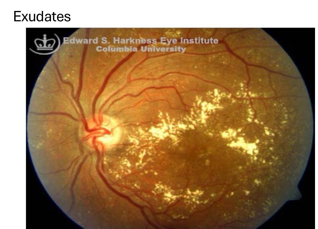 <p>exudates can lead to fibrotic scarring and loss of retinal structures</p><ul><li><p>photoreceptor damage</p></li></ul><p></p>