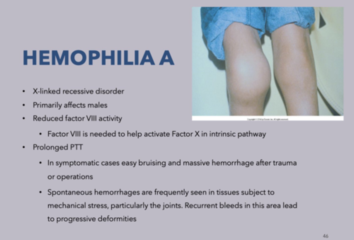 <p>Hemophilia A</p>
