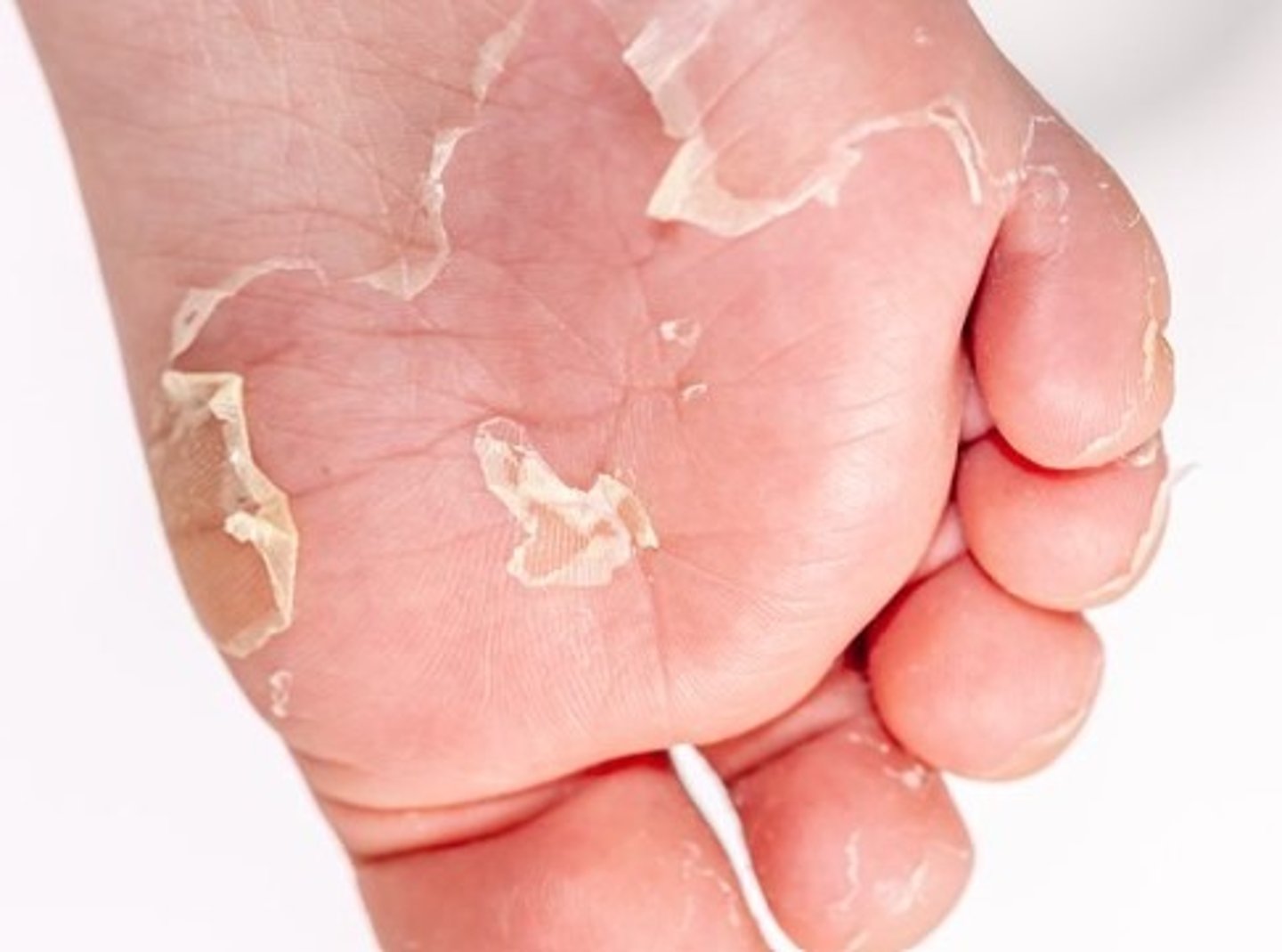 <p>scalded skin syndrome</p>