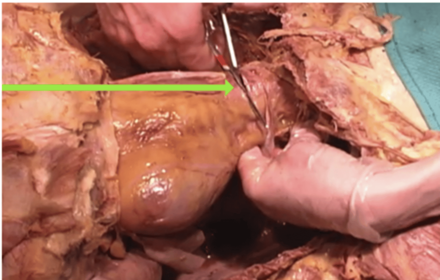 <p>What structure is being cut at this moment?</p><p>aorta</p><p>inferior vena cava</p><p>pericardial sac</p><p>superior vena cava</p>