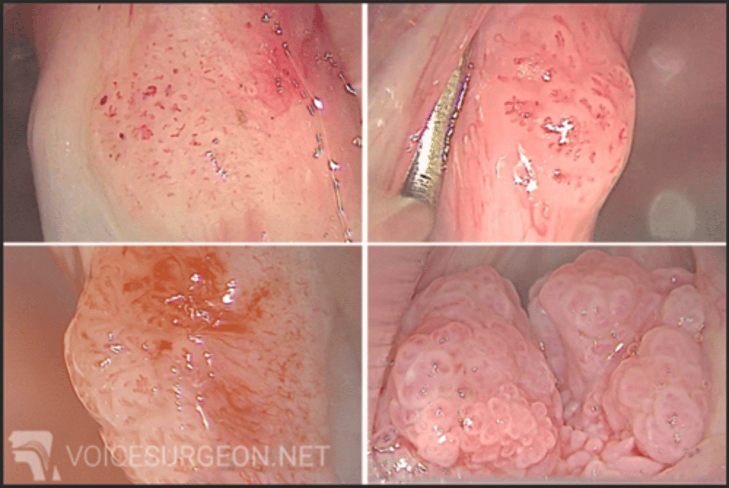 <p>-manifestation of HPV 6 and 11 in neonates that results in recurrent benign laryngeal tumors in children</p><p>•Progressive dysphonia, stridor, chronic cough, recurrent URTI, hemoptysis</p><p>•PE-&gt; reveals multiple verrucous, polypoid growths overlying the true vocal folds, false vocal folds, subglottic region, and trachea.</p>