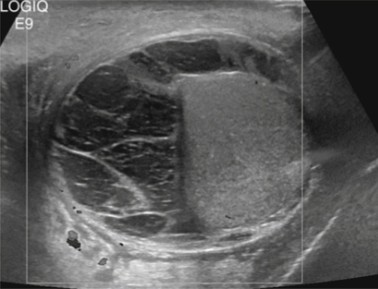 <p>A patient recently had surgery to the testicular area and this was seen on the US. What can be assumed here?</p>