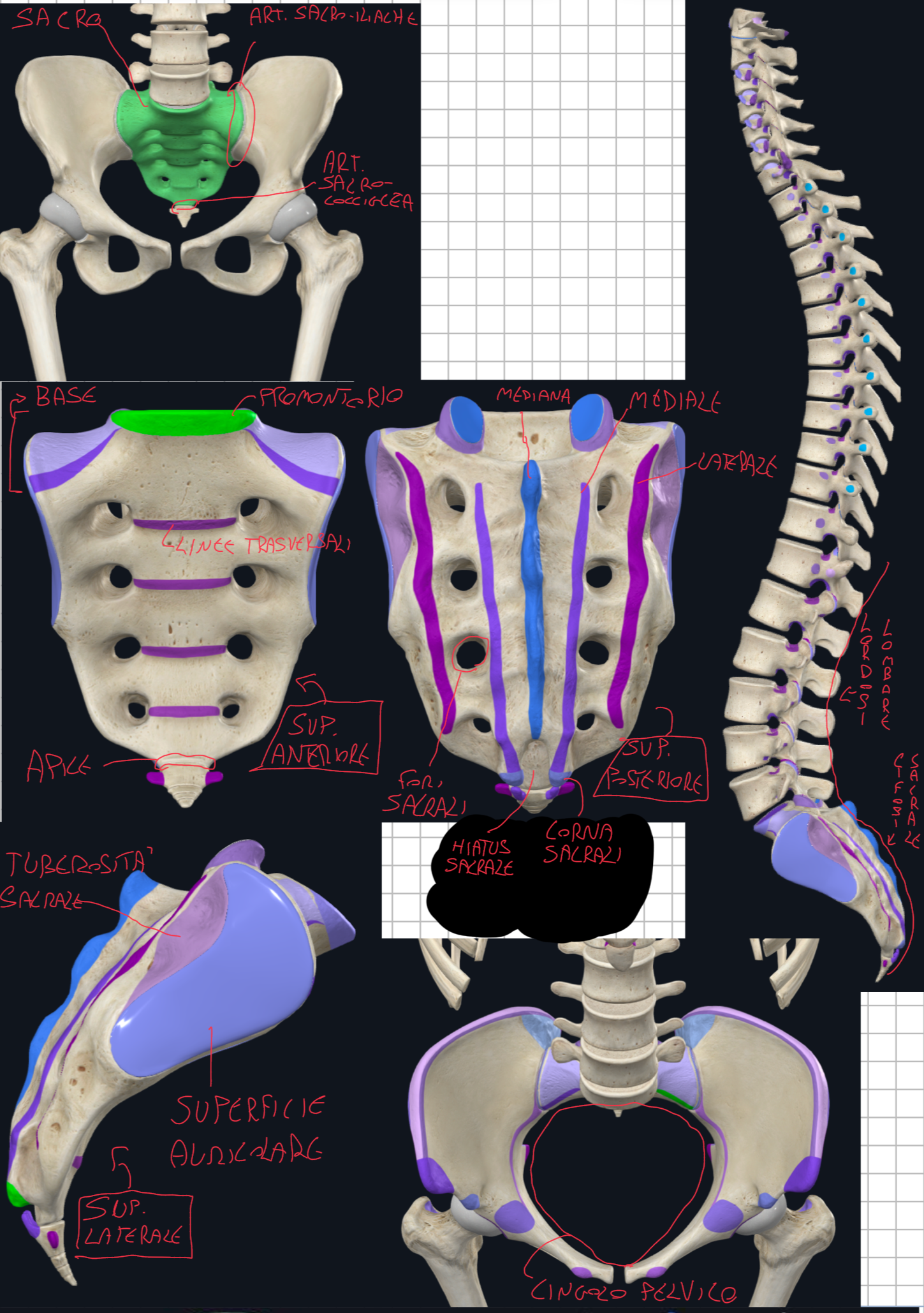 <p>Osso Sacro:</p><ul><li><p>Forma triangolare con base in alto e apice in basso, dovuta alla rapida riduzione delle dimensioni delle 5 vertebre sacrali che si uniscono</p></li><li><p>Funzione → trasferisce il peso corporeo dalla colonna al cingolo pelvico attraverso le articolazioni sacro-iliache.</p></li></ul><p>Base del sacro:</p><ul><li><p>formata da corpo e masse laterali della S1 dove sul margine anteriore forma il Promontorio (clinicamente importante per valutare l’ampiezza pelvica)</p></li><li><p>a questo livello si forma l’angolo lombosacrale (130-160 gradi) dove la lordosi lombare si continua nella cifosi sacrale</p></li></ul><p>Superficie laterale:</p><ul><li><p>Vista dall’alto ricorda un padiglione auricolare, infatti è detta superficie auricolare</p></li><li><p>E’ ricoperta da cartilagine e partecipa alla articolazione sinoviale sacro-iliaca&nbsp;</p></li><li><p>Posteriormente continua nella tuberosità sacrale, dove si realizza una sindesmosi (articolazione fibrosa)</p></li></ul><p>Superficie Pelvica (anteriore):</p><ul><li><p>Concava, liscia con linee trasversali → segni della fusione dei corpi vertebrali sacrali</p></li></ul><p>Superficie Dorsale (posteriore), ricca di rilievi ossei:</p><ul><li><p>Cresta Sacrale Mediana → fusione dei processi spinosi</p></li><li><p>Cresta Sacrale Mediale → fusione dei processi articolari</p></li><li><p>Cresta Sacrale Laterale → fusione dei processi trasversi</p></li><li><p>Le ultime vertebre sacrali S4-S5, non hanno lamine né processi spinosi → questo è clinicamente importante perché il canale vertebrale è più accessibile per l’anestesia epidurale (attraverso il hiatus sacrale delimitato dalle corna sacrali)</p></li></ul><p>Fori Sacrali:</p><ul><li><p>Presenti su entrambe le superfici, anteriore e posteriore&nbsp;dove passano i rami dei nervi spinali sacrali</p></li></ul><p>Coccige:</p><ul><li><p>Si articola con l’apice del sacro, ed è costituito da 3-4 vertebre rudimentali più piccole e anch’esse fuse tra loro</p></li><li><p>Non partecipa alla trasmissione del peso corporeo, ma è sede di inserzioni muscolari e legamentose.</p></li></ul><p></p>