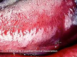 <p>white</p><p>raised</p><p>feather or corrugated pattern</p><p>on sides of tongue</p><p>can’t be scraped off</p>