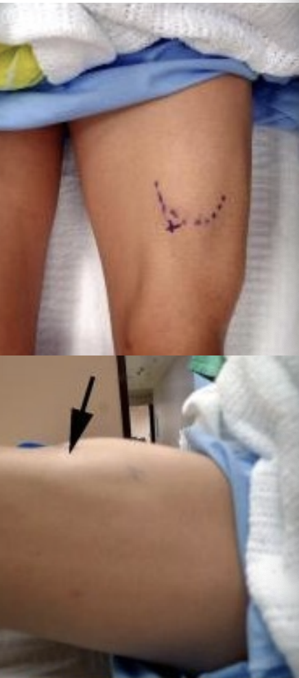 <p>Thigh Strains Treatment</p>