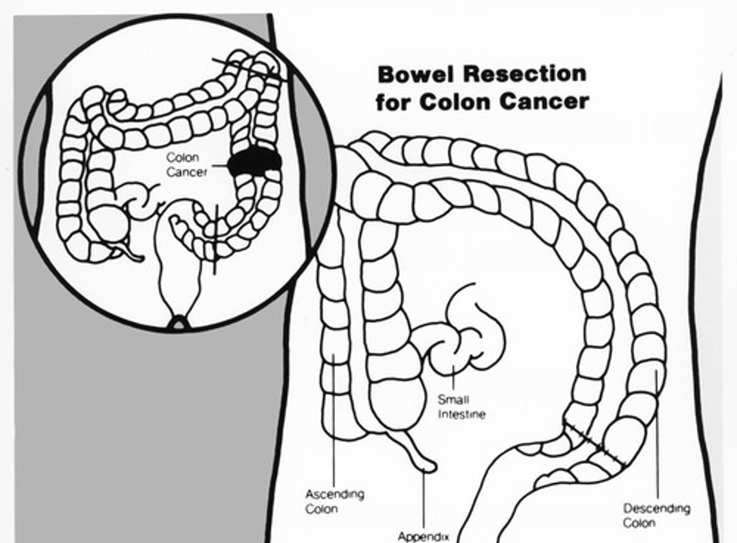 <p>Surgical removal, bowel resection, tumor removal, lymph node removal, chemotherapy, and targeted biologic therapy.</p>