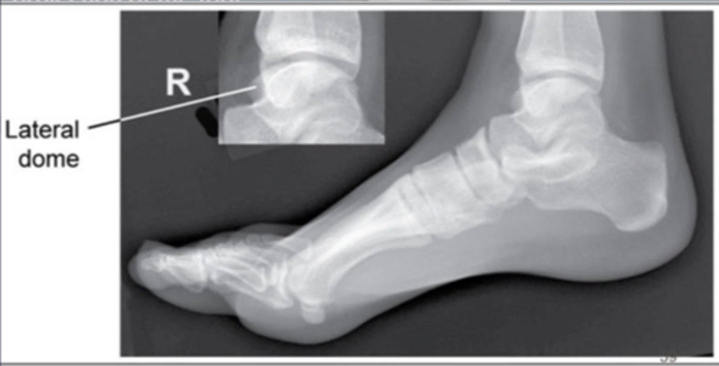 <p>Toes elevated</p>