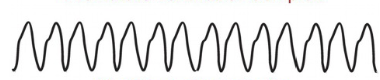 - HR 100-280 bpm
- Can be sustained or non-sustained (paroxysmal)
