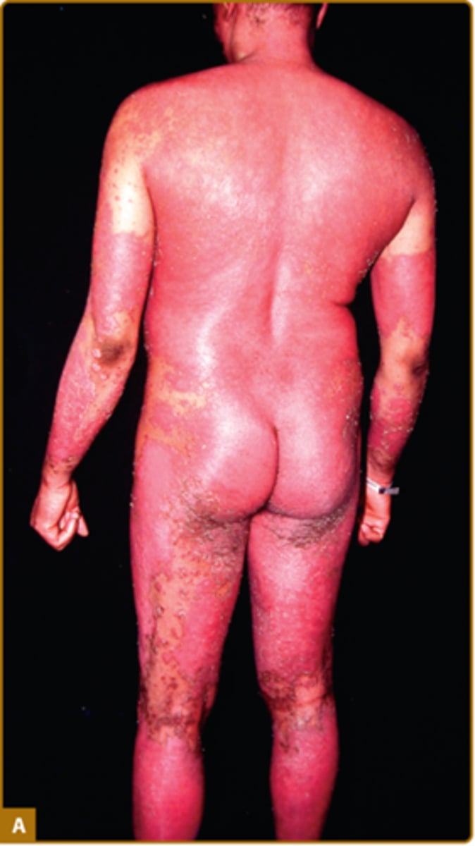 <p>Erythrodermic psoriasis</p>