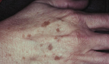 <p>what is this lesion </p>