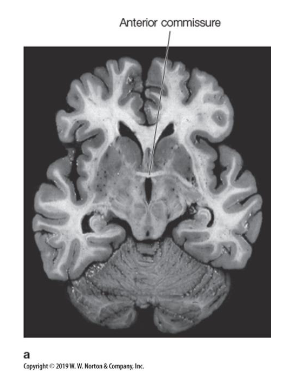 <p>• primarily connects certain areas of temporal lobe and amygdala</p>