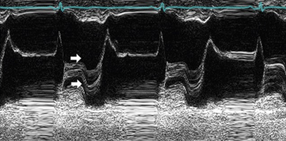 <p>a "droopy" C-point due to the valve bulging into LV during closure</p>