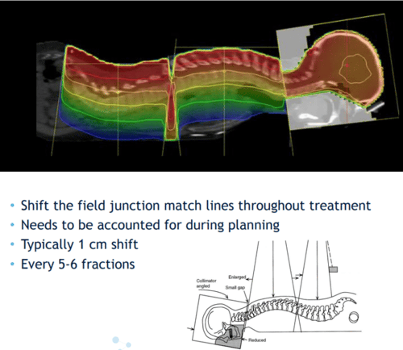 <p>A. the length of the lateral brain field in the direction of the junction of the lateral brain field and the posterior spine field</p><p>B. the treatment distance where the lateral brain field size is defined</p>