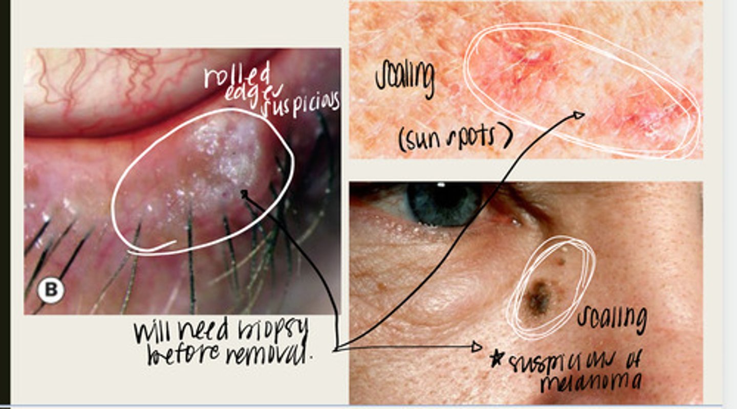 <p>What is the presentation of actinic keratosis (solar keratosis)?</p>