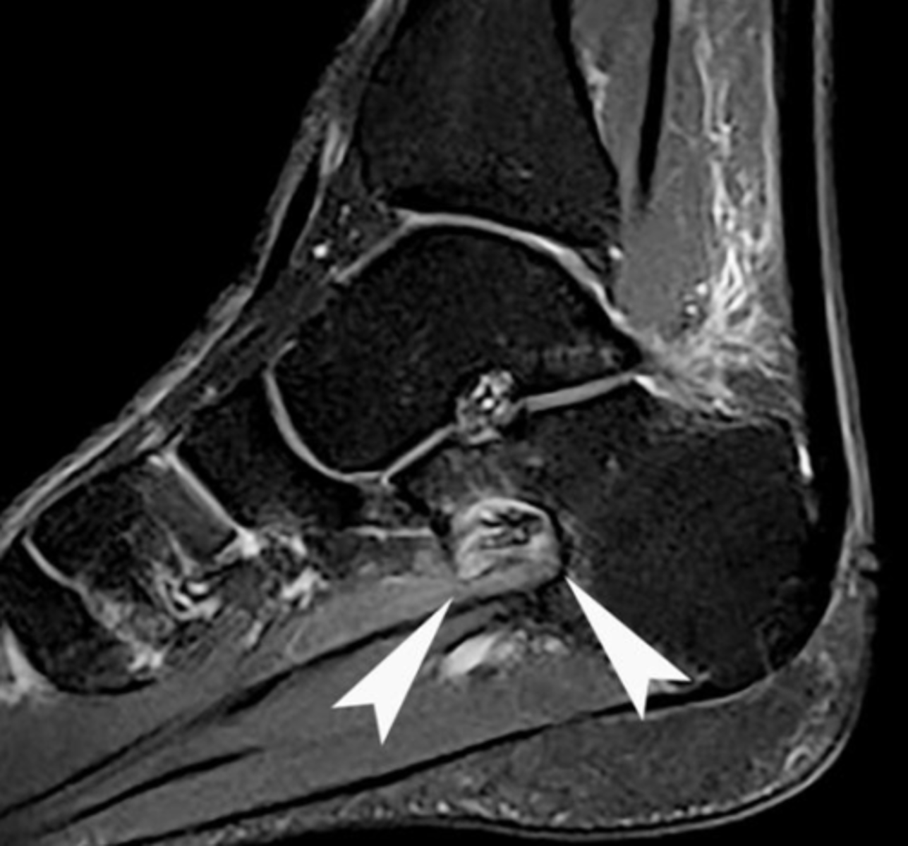 <p>• Very sensitive for soft tissue imaging</p><p>• Utilisation of different sequences can assist in FB detection</p><p>• 3D reconstruction is available</p>