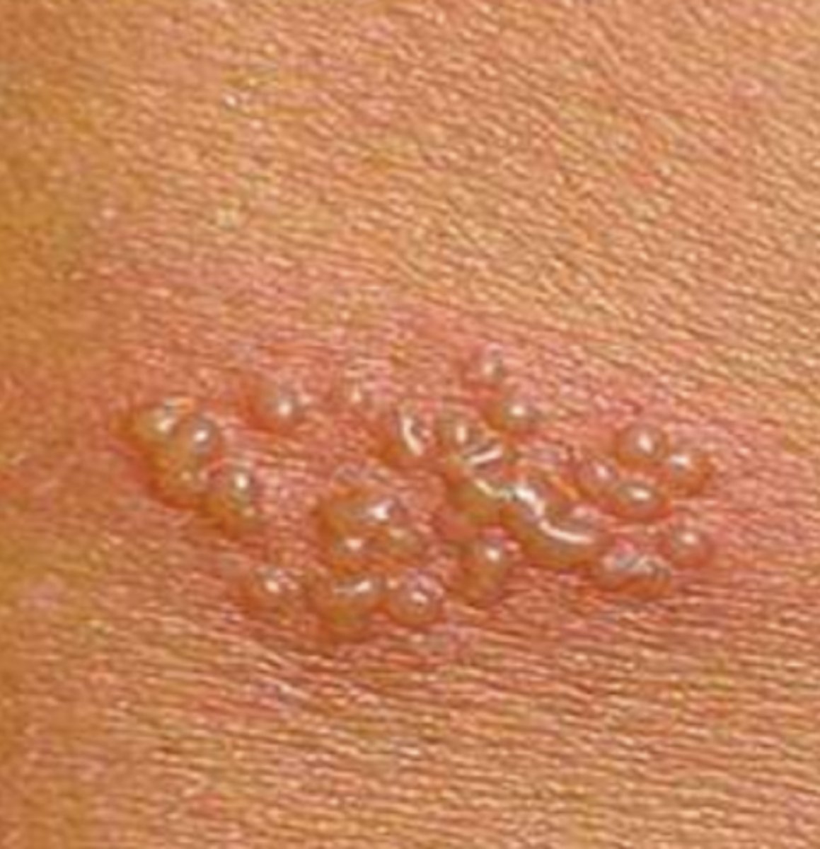 <p>¿lesión?</p><p>¿primaria o secundaria?</p>