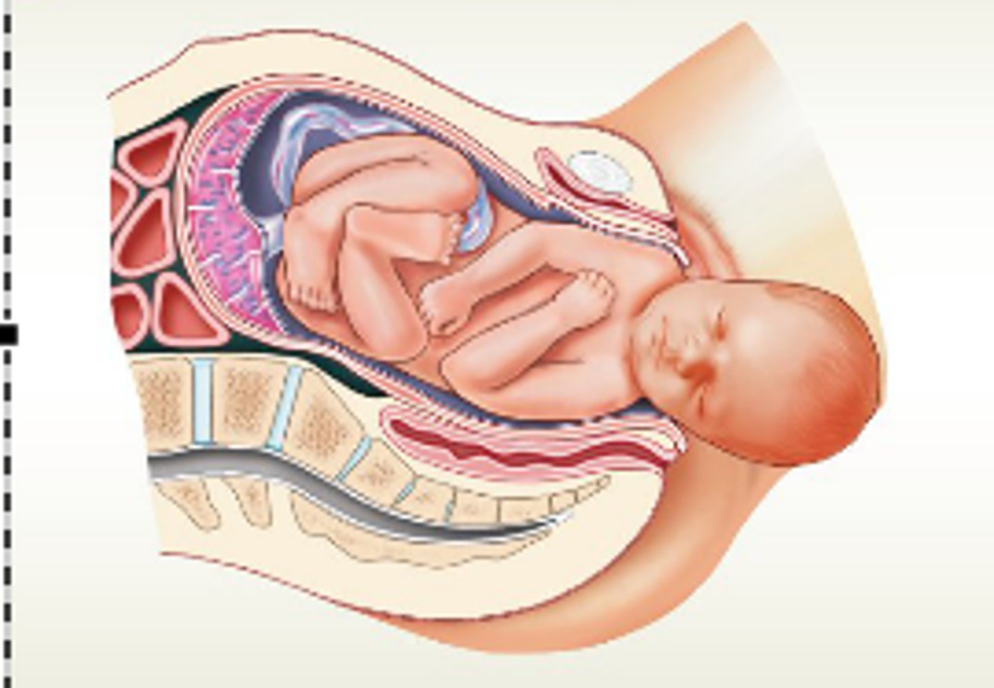 <p>a. Expulsion begins when baby's head enters vagina and lasts until baby is expelled, up to 30 minutes</p><p>b. Crowning—when the baby's head is visible</p><p>-Delivery of the head is the most difficult part</p><p>-Nose and mouth suctioned before delivery to clear airway</p><p>c. After expulsion, attendant drains blood from umbilical vein into baby</p><p>-Clamps umbilical cord in two places; cuts cord between clamps</p>